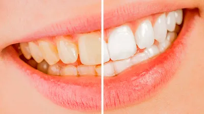 Teeth whitening before and after
