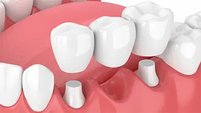 Dental bridges