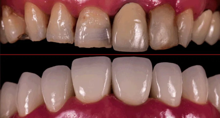 veneers before and after