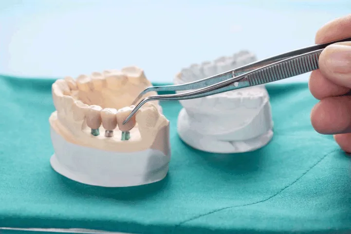 dental bridge concept