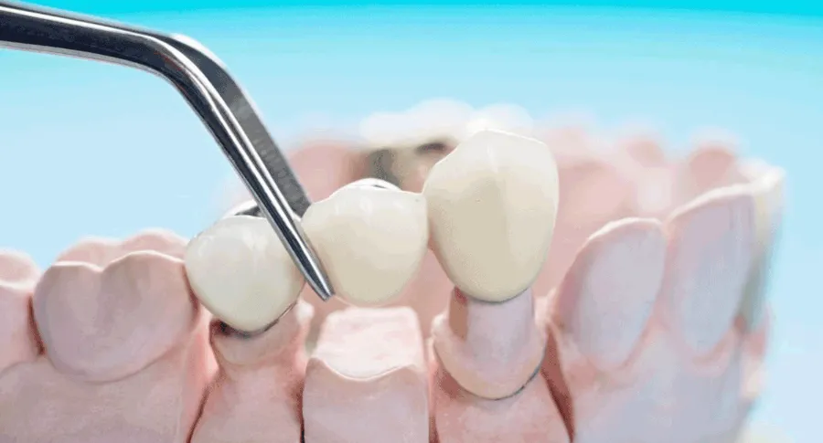 dental bridge concept