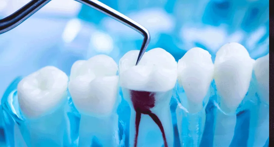 Root canal example model