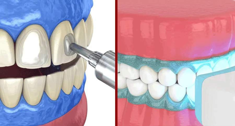 Teeth whitening concept