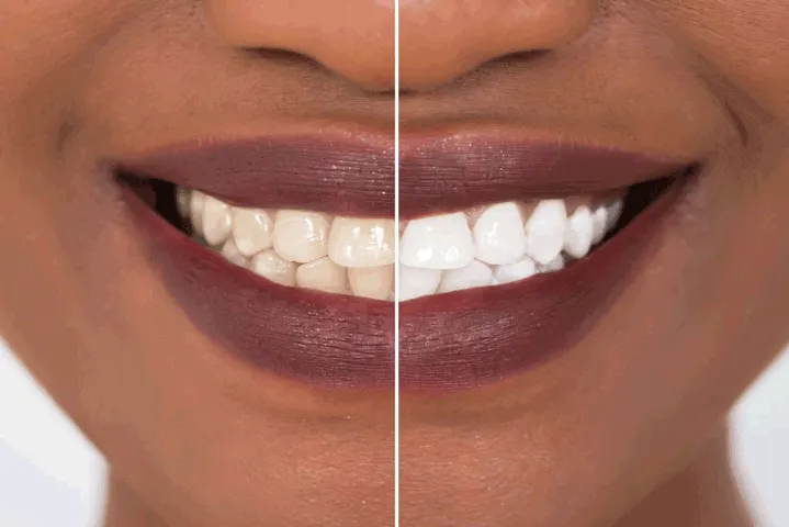 Teeth whitening before and after