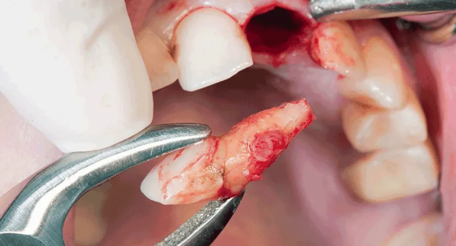 Holding after removal