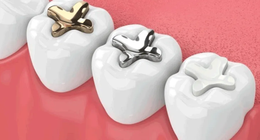 teeth with different types of fillings