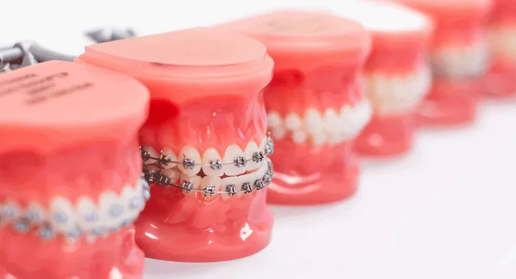 different types of braces