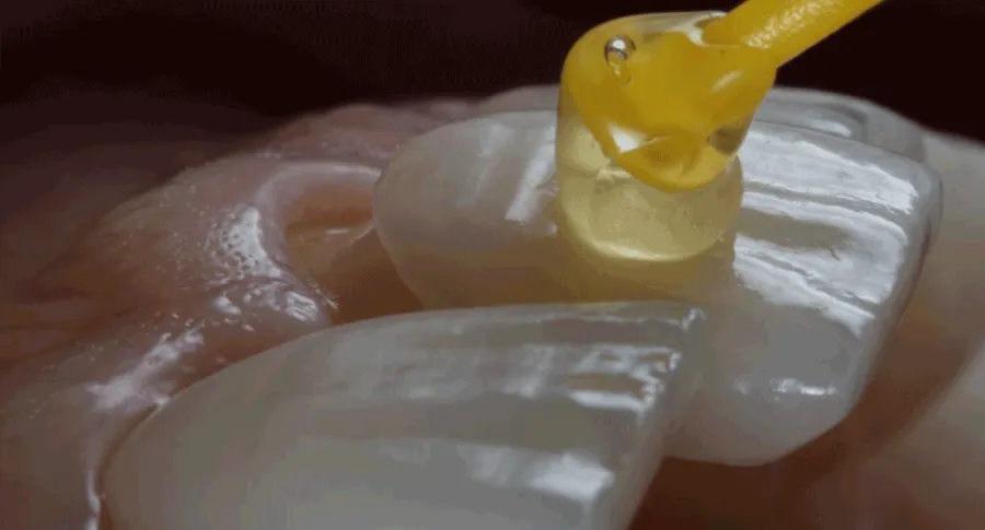 veneer installation process