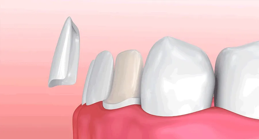 veneer installation process