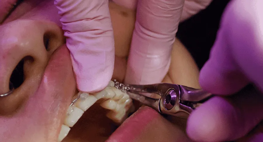 Jaw wiring installation process