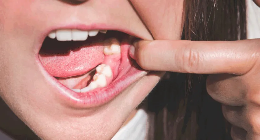 woman opening mouth with missing teeth