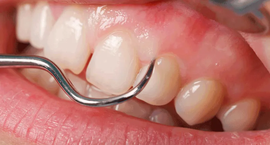 closeup Gum therapy process