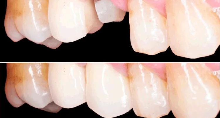 Dental Crown before and after