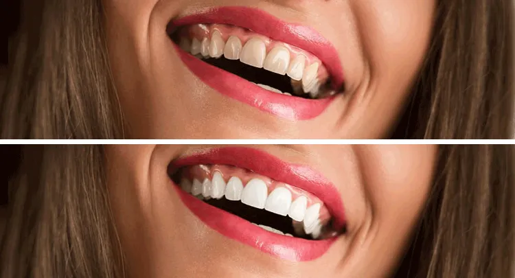 Smile Makeover before and after