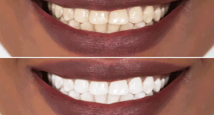 Teeth Whitening before and after