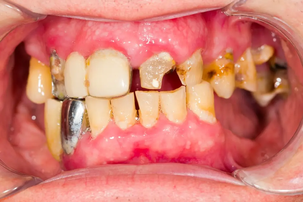 rotten teeth closeup look