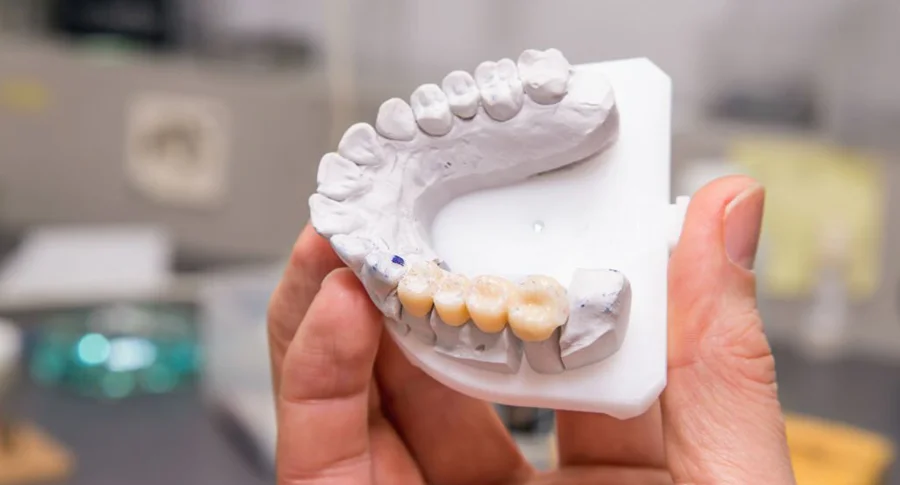 dental bridges sample