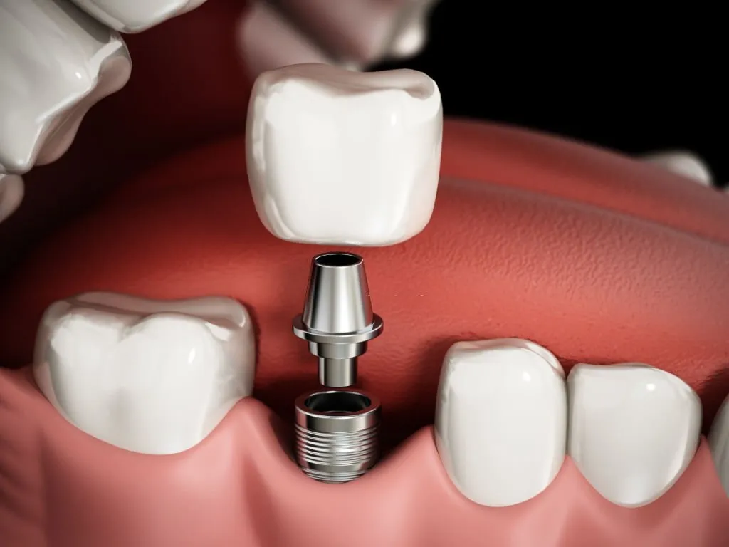 Dental implant sample
