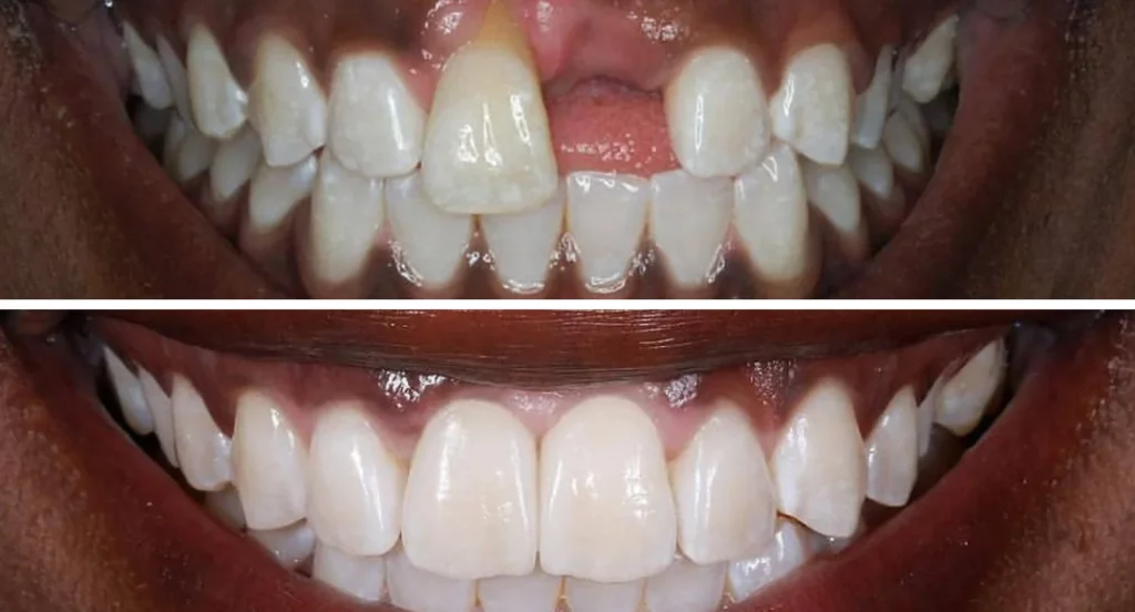 Before and after dental veneers