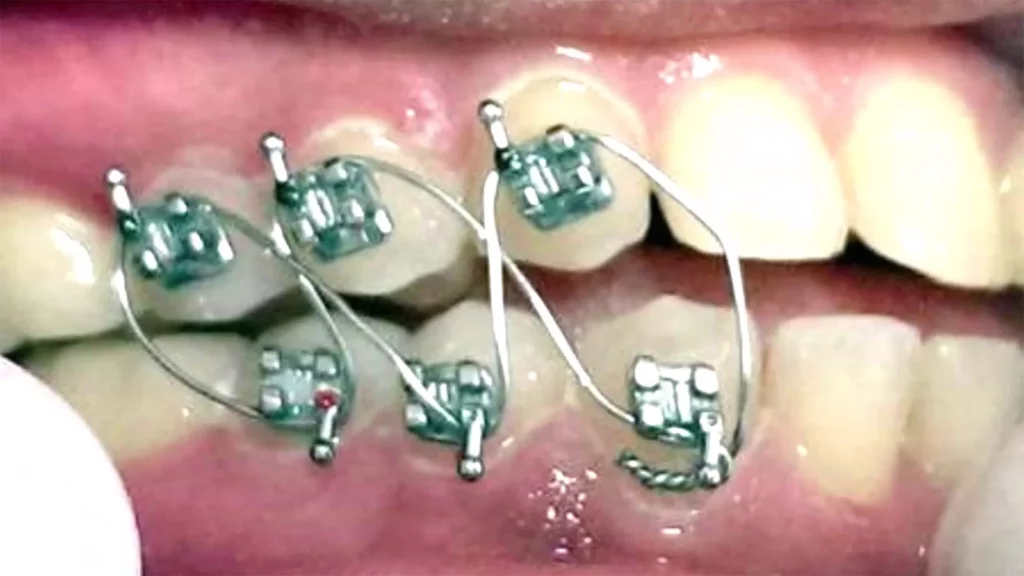 close up photo of slimming wires